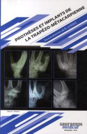 Prothèses et implants de la trapézo métacarpienne  - Bruno Lussiez 
